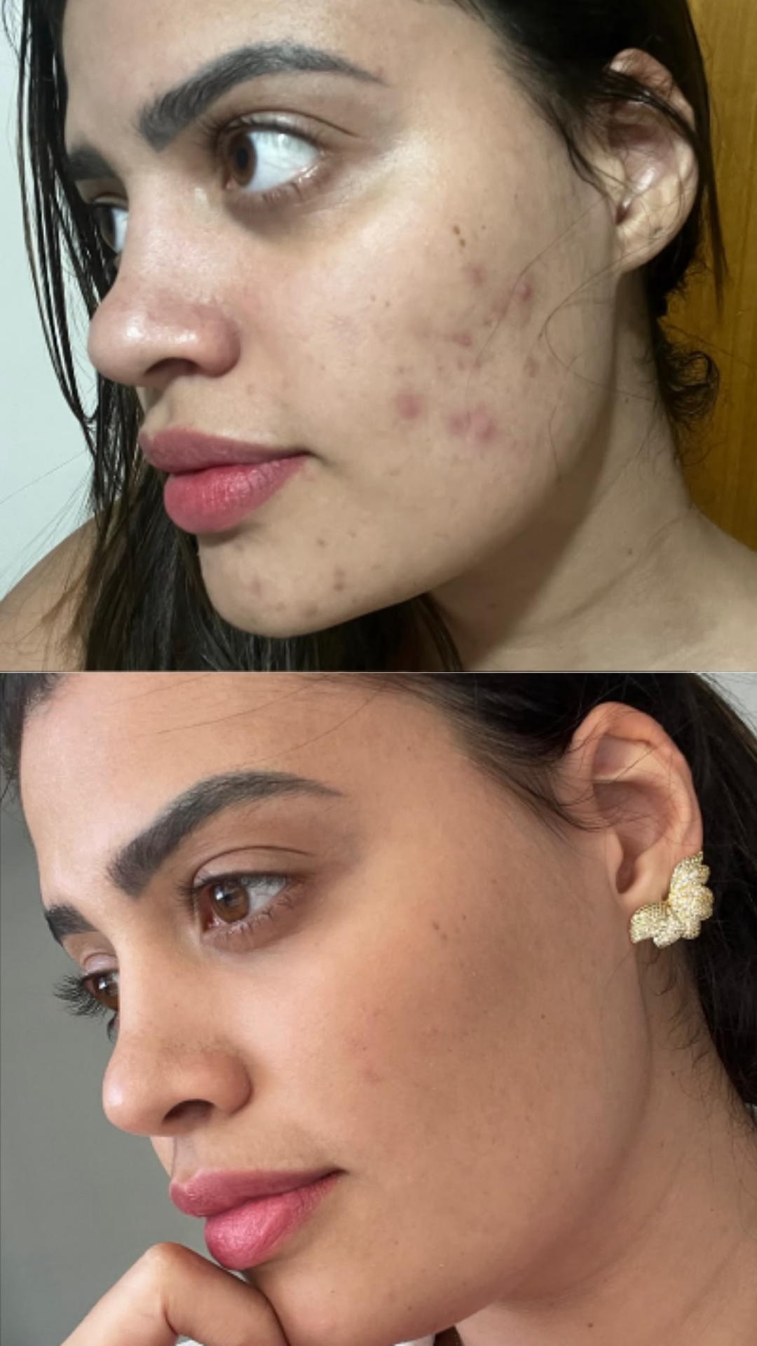 Tratamento de Acne