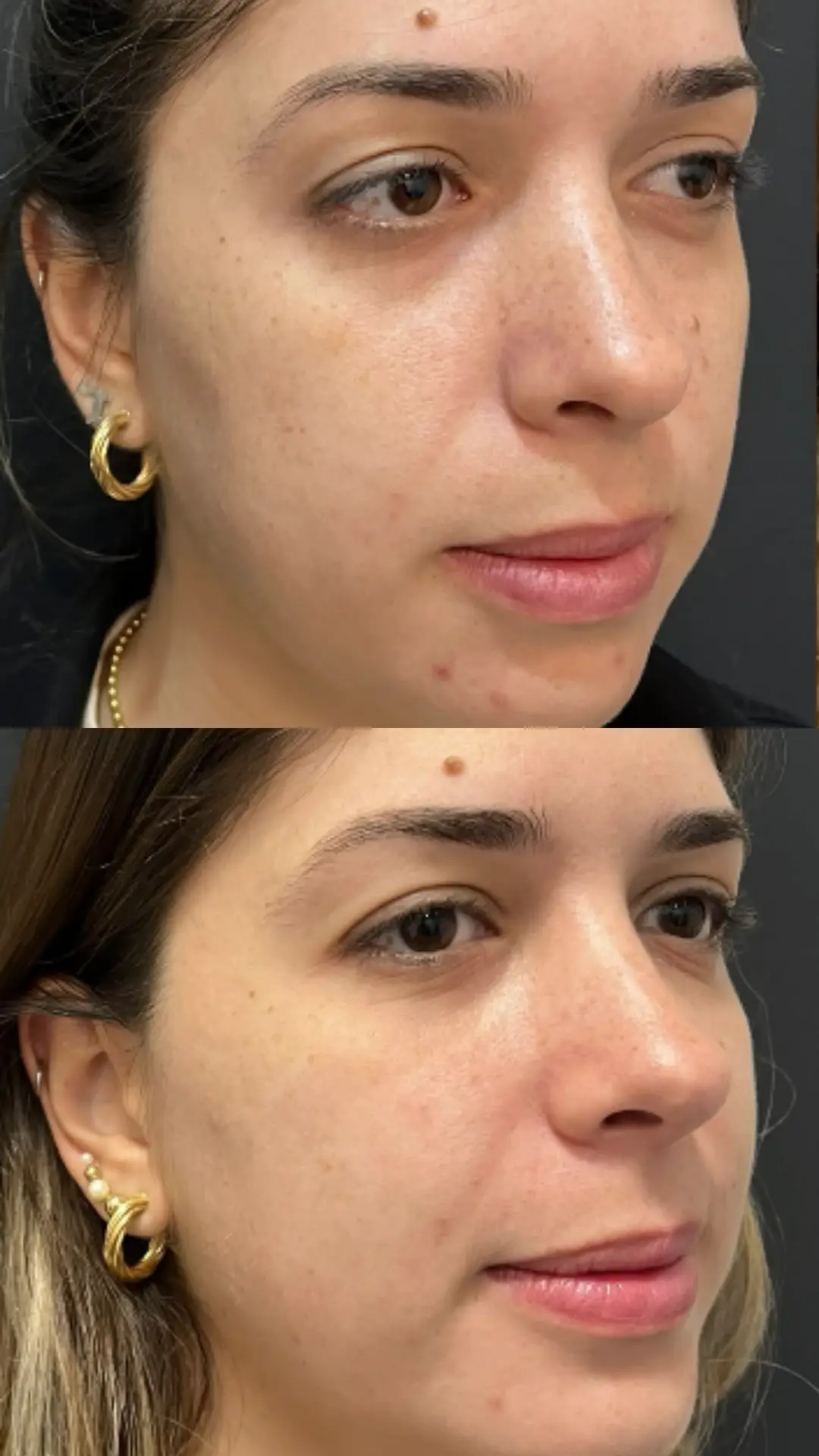 Harmonização Facial
