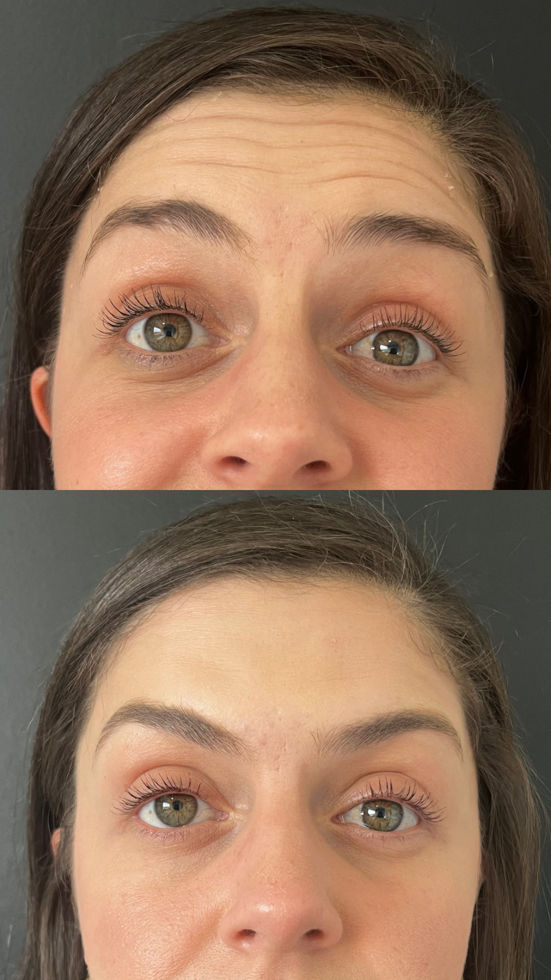 Botox