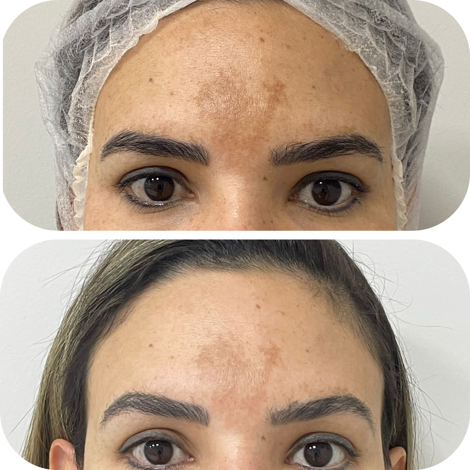 Melasma & Manchas
